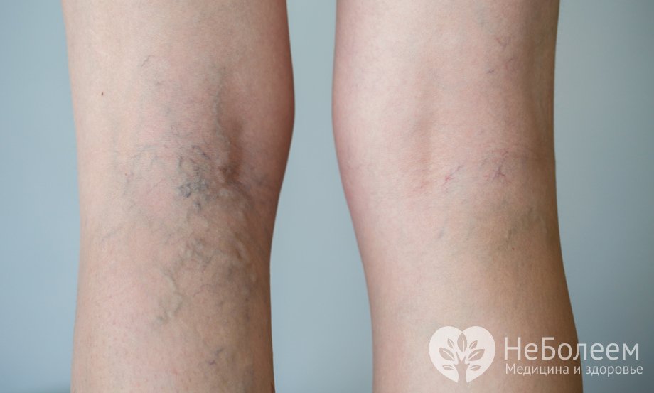Признаки венозной недостаточности