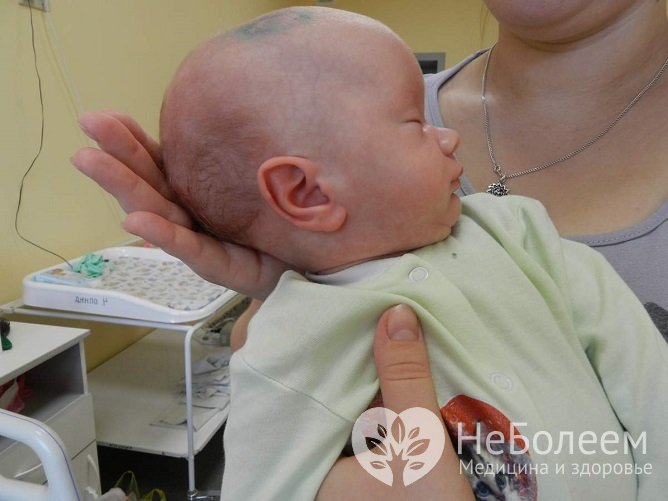 Распознать водянку головного мозга у детей можно по характерной форме черепа