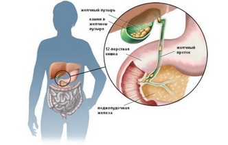 7 домашних средств, помогающих при желчнокаменной болезни