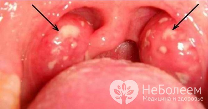 Вид небных миндалин при ангине варьирует в зависимости от формы болезни