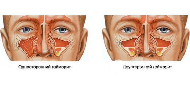 Гайморит может быть одно- или двусторонним