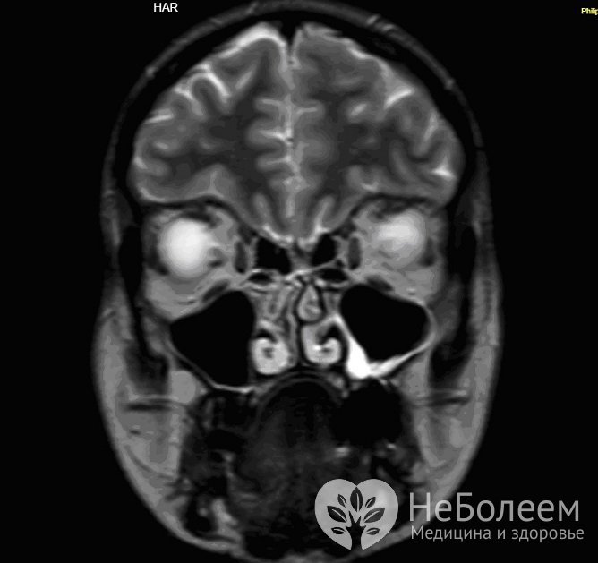 Для уточнения диагноза может быть назначена магнитно-резонансная томография гайморовых пазух