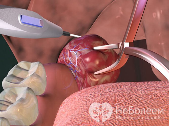 В случае необходимости проводится оперативное вмешательство