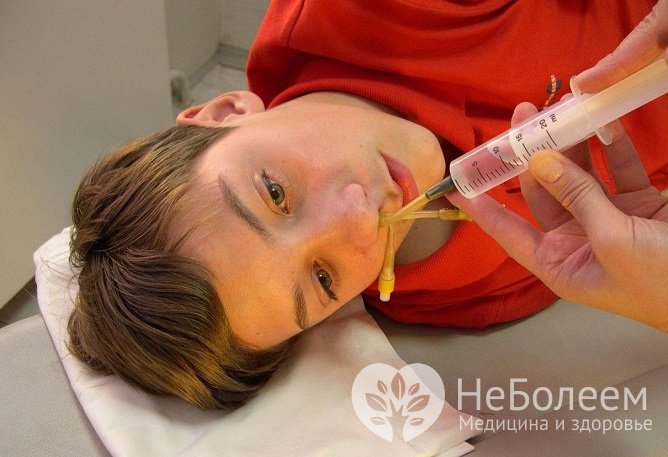 Основным методом лечения аденоидов у детей является местная противовоспалительная терапия