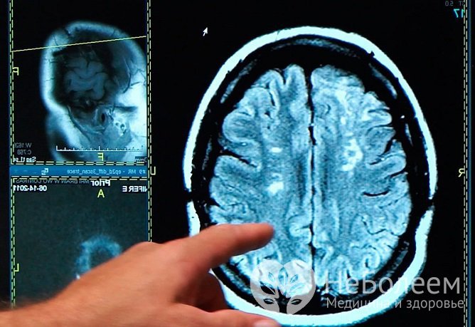 Исход инсульта во многом зависит не только от величины поражения, но и от того, какая именно область мозга задета