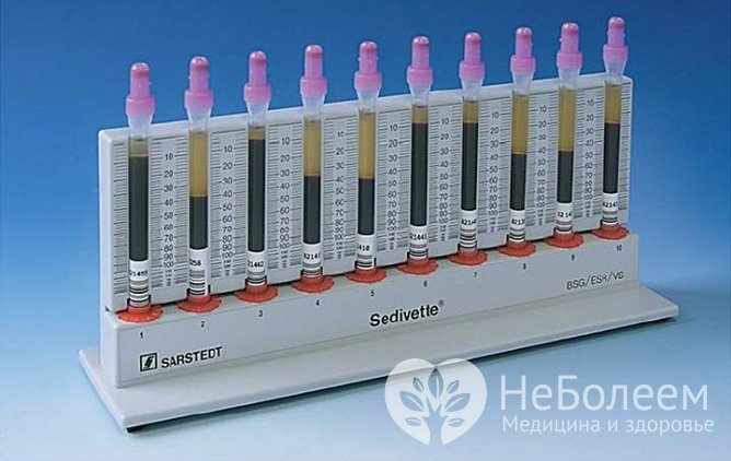 Скорость оседания эритроцитов изменяется на фоне развития разных заболеваний