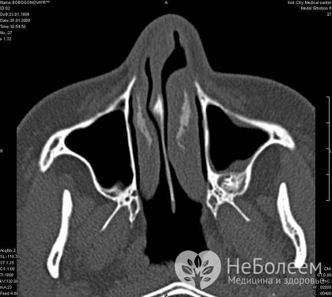 Один из предрасполагающих факторов развития патологии – искривление носовой перегородки