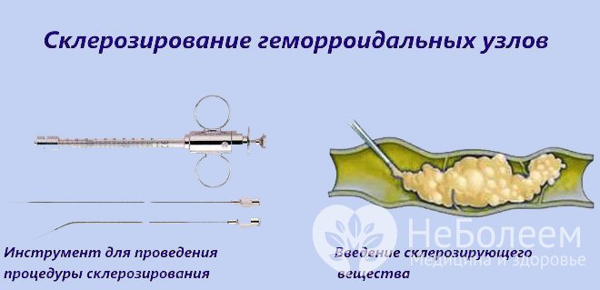 Склеротерапия геморроидальных узлов – малоинвазивная процедура, которая занимает примерно 10 минут