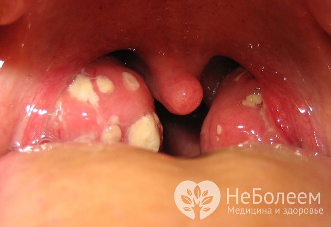 При присоединении бактериальной инфекции возможно появление гнойничков на миндалинах