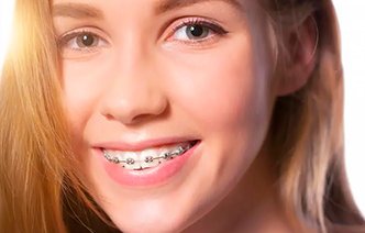 Можно ли ставить брекеты при проблемах с деснами