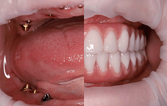 Больно ли ставить зубной имплант?