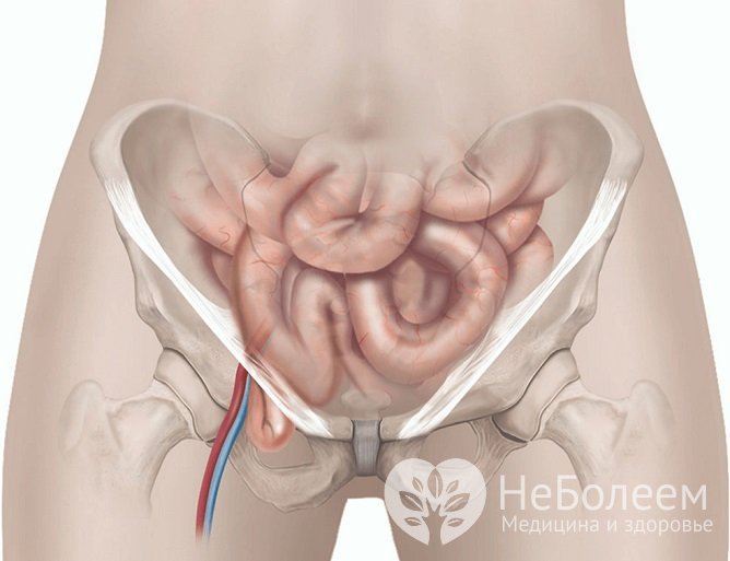Бедренные грыжи образуются из-за слабости брюшной стенки на фоне повышения внутрибрюшного давления