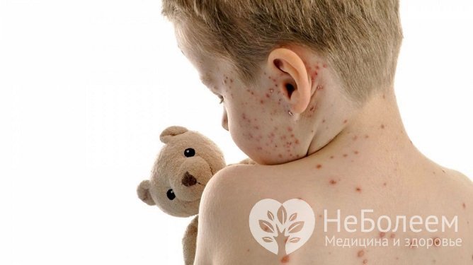 Ветрянка у детей: симптомы, лечение, осложнения, профилактика
